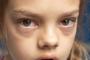 Irritated eyes of a girl who got sick with conjunctivitis