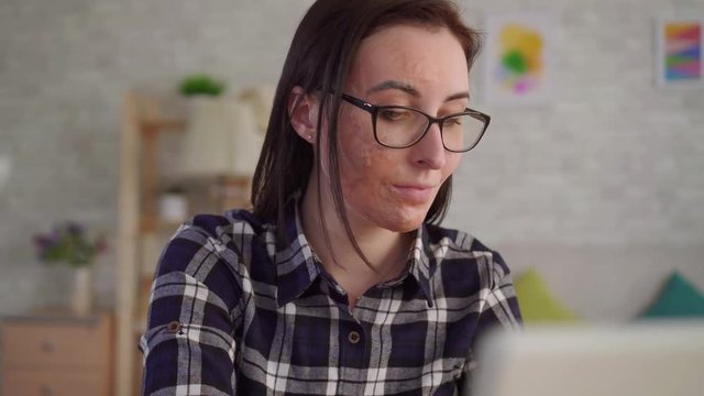 Close up young woman with a scar from a burn on her face uses a laptop
