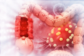 Colon cancer. Cancer attacking cell. Colon disease concept