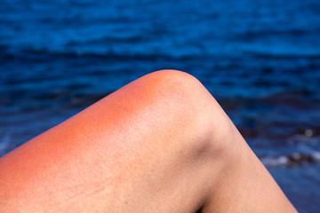 Woman leg with red sunburn skin on blue sea background. Sun burned skin redness and irritation.