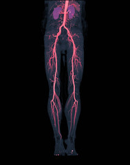 CTA femoral artery run off  3D MIP image ( Red ) of femoral artery with kidney for Patients...
