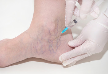 Obraz na płótnie Canvas Spider veins on the womans legs, sclerotherapy treatment