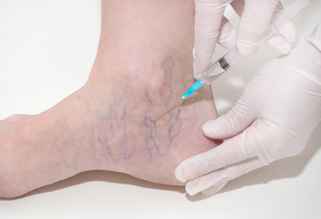 Spider veins on the womans legs, sclerotherapy treatment