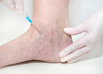 Spider veins on the womans legs, sclerotherapy treatment
