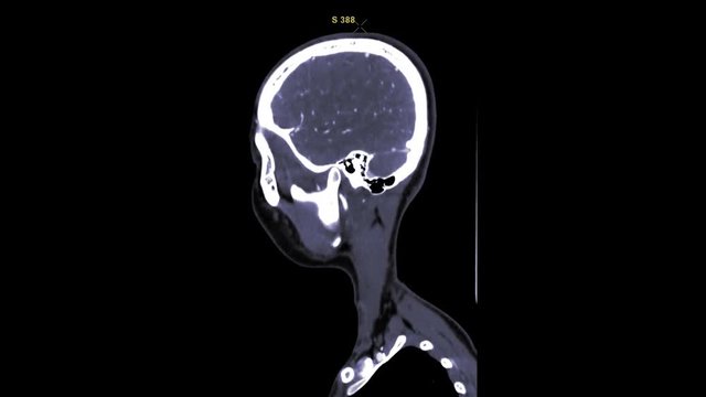 slow motion of CTA brain  or  CT brain  Sagittal view  with injecting contrast media for diagnosis arterial disease.