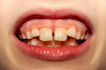 Caucasian European school boy showing his projecting upper front teeth