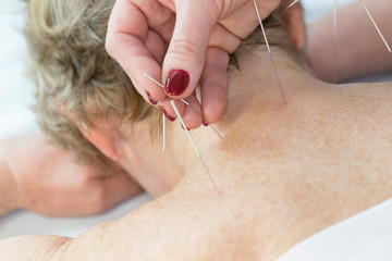 Elderly woman undergoing acupuncture procedure in a fat spa. 
