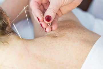 Elderly woman undergoing acupuncture procedure in a fat spa. 
