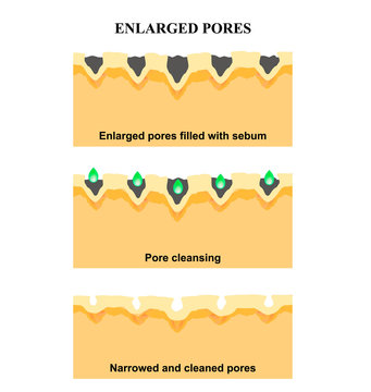 Enlarged pores. The structure of the skin. Wrinkles, acne scar. Cleansing and narrowing the pores. Infographics. Vector illustration on isolated background.