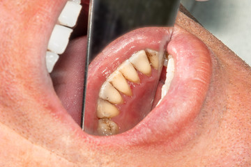 human teeth with smoking plaque and tartar. Close-up macro in dental clinic. Hygiene concept
