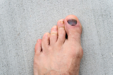 Nail hematoma. Take care of your feet. Pedicure and podiatry. Treatment of bruise and fracture....