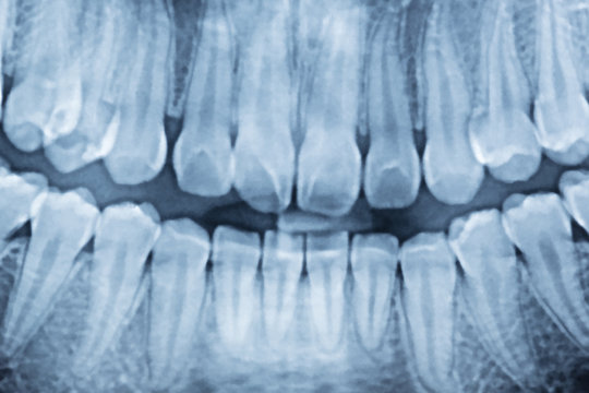 panoramic dental x-ray of a mouth left and right side.