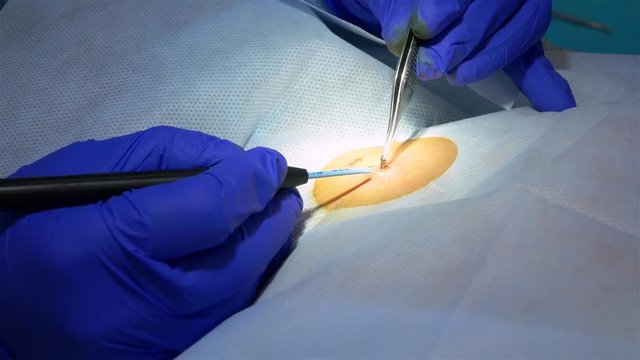 Close-up professional doctor removing mole in surgical procedure by cutting it out with medical tools and equipment