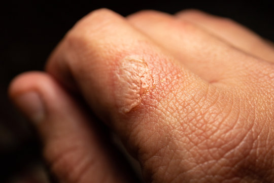 Snake bite of index finger in detailed macro image. Detail of wounding snake destroying tissues.