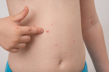 Baby with chicken pox rash. Varicella virus or Chickenpox bubble rash on child. Dermatology...