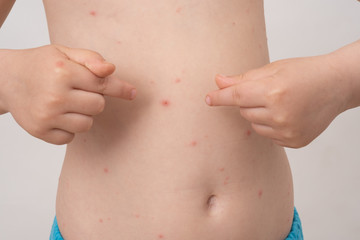 Baby with chicken pox rash. Varicella virus or Chickenpox bubble rash on child. Dermatology...