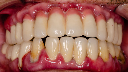 close up of a teeth with a severe, acute inflammation