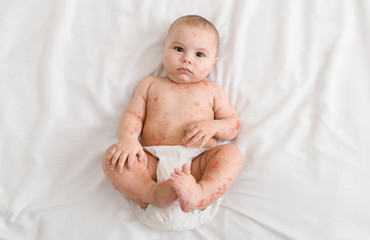 Upset newborn baby suffering from measles rash - obrazy, fototapety, plakaty