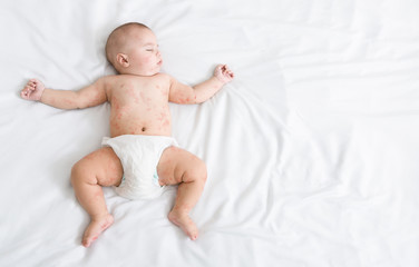 Newborn baby with measles rash sleeping on bed