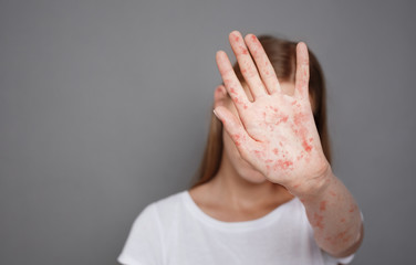Stop Measles. Girl With Virus Closing Face Over Grey Background