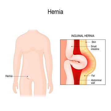 Inguinal Hernia. bowel exit through the wall of the abdomen cavity.