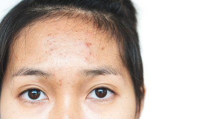 Acne on the forehead of a woman.