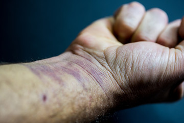 Fist closed, man's arm with bruises on his hand and wrist.
