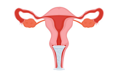 Female condom in the uterus