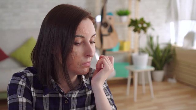 Sad young woman with a burn scar on her face sitting alone