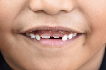 Naklejka premium Boy with front teeth for Los smiling.