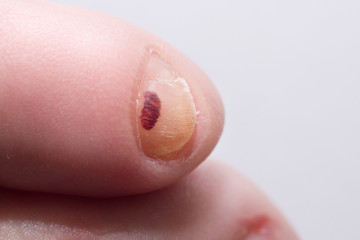 Fototapeta premium Fifth left toe damage and nail disease after bruise
