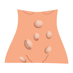 Types of hernia. Epigastric, Lateral, Umbilical, Inguinal, femoral, incisional hernia. intestinal hernia. Infographics. Vector illustration on isolated background.