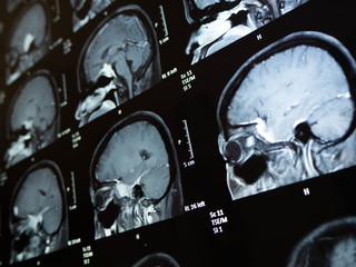 Film x ray brain tumor my mather ,Bangkok,Thailand