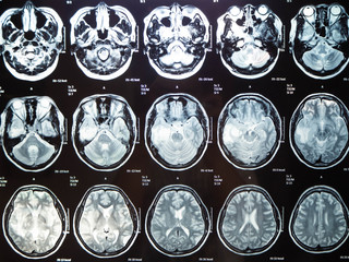 Film x ray brain tumor my mather ,Bangkok,Thailand