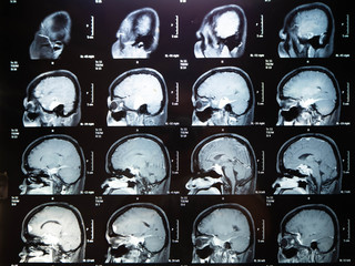 Film x ray brain tumor my mather ,Bangkok,Thailand