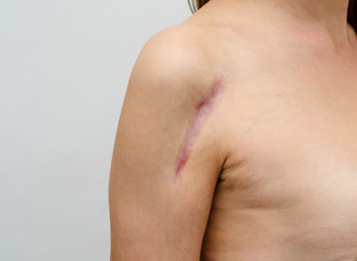 Close up of female shoulder with a scar after install a metal plate  bone fracture surgically....