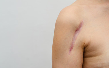Close up of female shoulder with a scar after install a metal plate bone fracture surgically....