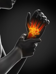 3d rendered medically accurate illustration of painful wrist
