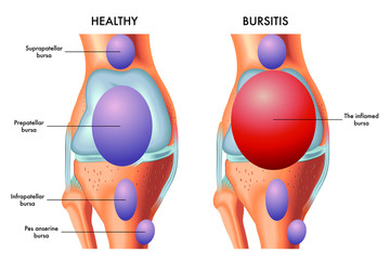 A medical illustration of a knee with an inflamed prepatellar bursa in comparison with a healthy knee. - obrazy, fototapety, plakaty
