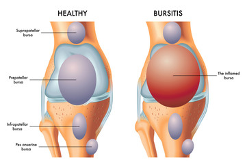 A medical illustration of a knee with an inflamed prepatellar bursa in comparison with a healthy knee. 