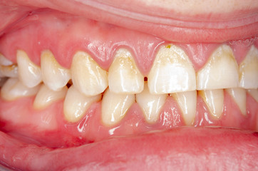 gingivitis and dental plaque closeup of a juvenile dentitiion
