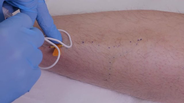 Innovative method of varicose veins surgery, sclerotherapy procedure. Close-up shot of patient leg.