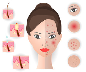 The face of a woman with skin problems. Wrinkles, acne, couperose, black dots. Vector