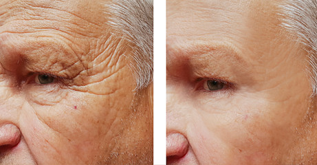 Elderly male face wrinkles before and after correction procedures