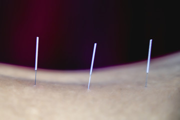 Acupuncture
