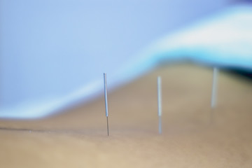 Acupuncture