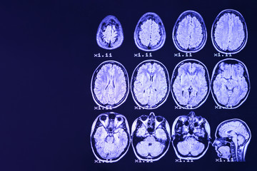 MRI of the brain on a black background with blue  backlight. Right  place for advertising inscription