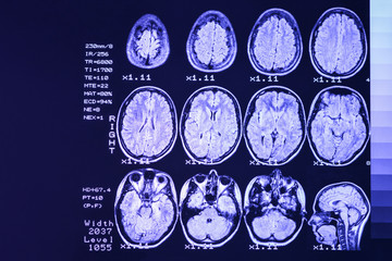 MRI scan or magnetic resonance image of head and brain scan. The result is an MRI of the brain with values and numbers with lilac  backlight..