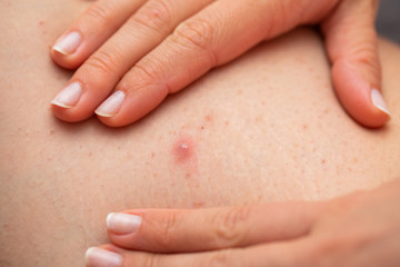Folliculitis on female leg - squeezing