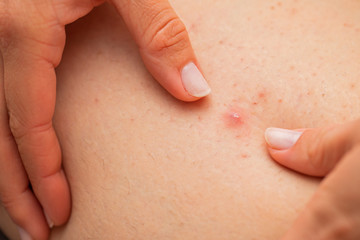 Folliculitis on female leg - squeezing